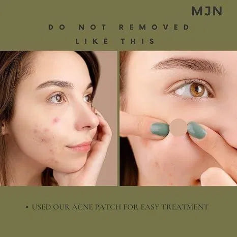 Acne Clearing Pimple Patches (Pack of 2) - 144 Patches